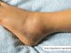 How Long Does It Take to Heal a Sprained Ankle? how long does a sprained ankle take to heal