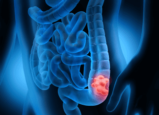 Signs of Colon Cancer in Women Not to Ignore! Signs of colon cancer in women not to ignore!