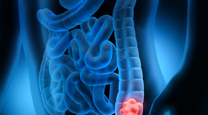 Signs of Colon Cancer in Women Not to Ignore! Signs of colon cancer in women not to ignore!