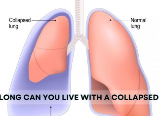 How Long Can You Live with a Collapsed Lung? How Long Can You Live with a Collapsed Lung