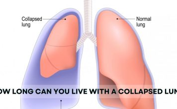 How Long Can You Live with a Collapsed Lung? How Long Can You Live with a Collapsed Lung