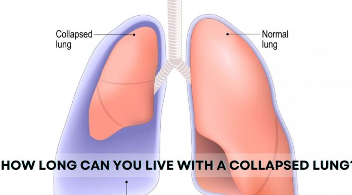 How Long Can You Live with a Collapsed Lung? How Long Can You Live with a Collapsed Lung