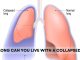 How Long Can You Live with a Collapsed Lung? How Long Can You Live with a Collapsed Lung