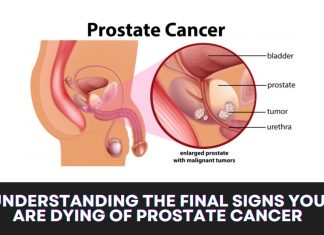 Understanding the Final Signs You Are Dying of Prostate Cancer Understanding the Final Signs You Are Dying of Prostate Cancer