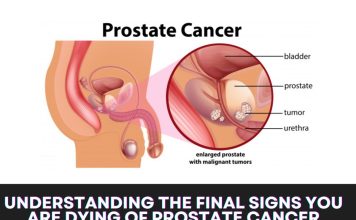 Understanding the Final Signs You Are Dying of Prostate Cancer Understanding the Final Signs You Are Dying of Prostate Cancer