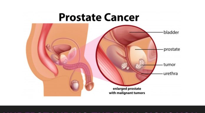 Understanding the Final Signs You Are Dying of Prostate Cancer Understanding the Final Signs You Are Dying of Prostate Cancer