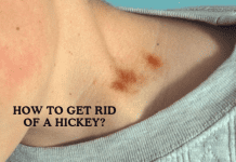 How To Get Rid Of A Hickey: Some Effective Ways To Consider! How To Get Rid Of A Hickey: