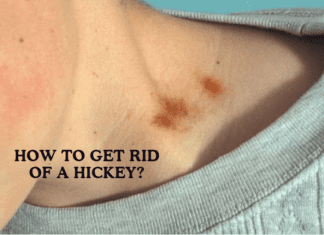 How To Get Rid Of A Hickey: Some Effective Ways To Consider! How To Get Rid Of A Hickey: