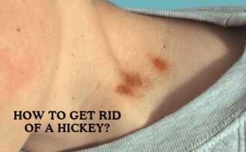 How To Get Rid Of A Hickey: Some Effective Ways To Consider! How To Get Rid Of A Hickey: