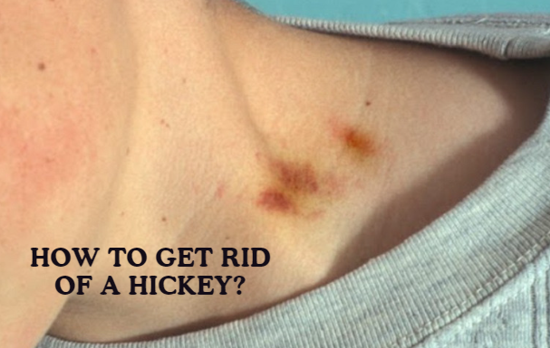 How To Get Rid Of A Hickey: Some Effective Ways To Consider! How To Get Rid Of A Hickey: