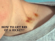 How To Get Rid Of A Hickey: Some Effective Ways To Consider! How To Get Rid Of A Hickey: