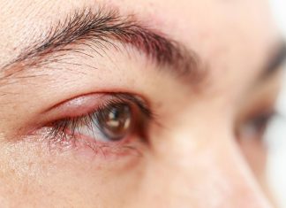 How To Get Rid Of A Stye Overnight: Effective Remedies And Treatment