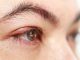 How To Get Rid Of A Stye Overnight: Effective Remedies And Treatment